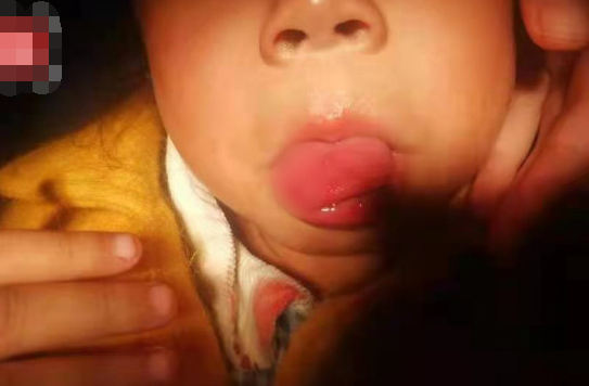  4岁女童幼儿园摔倒致舌头撕裂伤 究竟是怎么一回事？