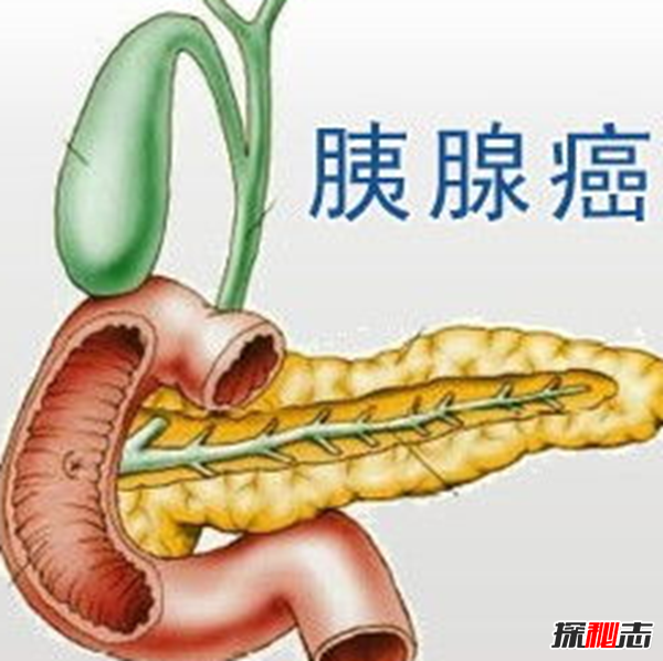 胰腺癌发病率最高的十大国家 无中国,日本榜上第七