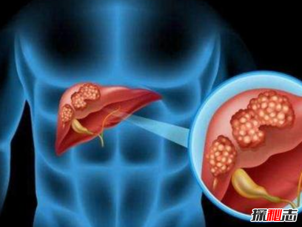 肝癌发病率最高的国家排名 埃及榜上第四,第一酒精过度依赖