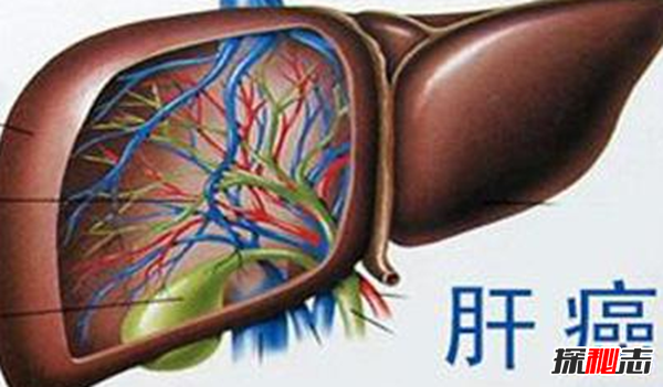 肝癌发病率最高的国家排名 埃及榜上第四,第一酒精过度依赖