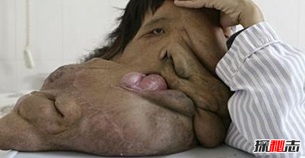 世界上长得最恐怖的人:湖南象人黄春才(脸上15公斤神经纤维瘤)