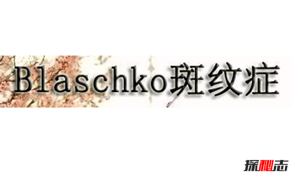 Blaschko斑纹症是什么?全身长满条纹的罕见怪病